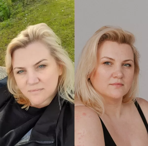Bez svara korekcijas. Izskats ko dod fizioloģiski pareiza limfas attece.